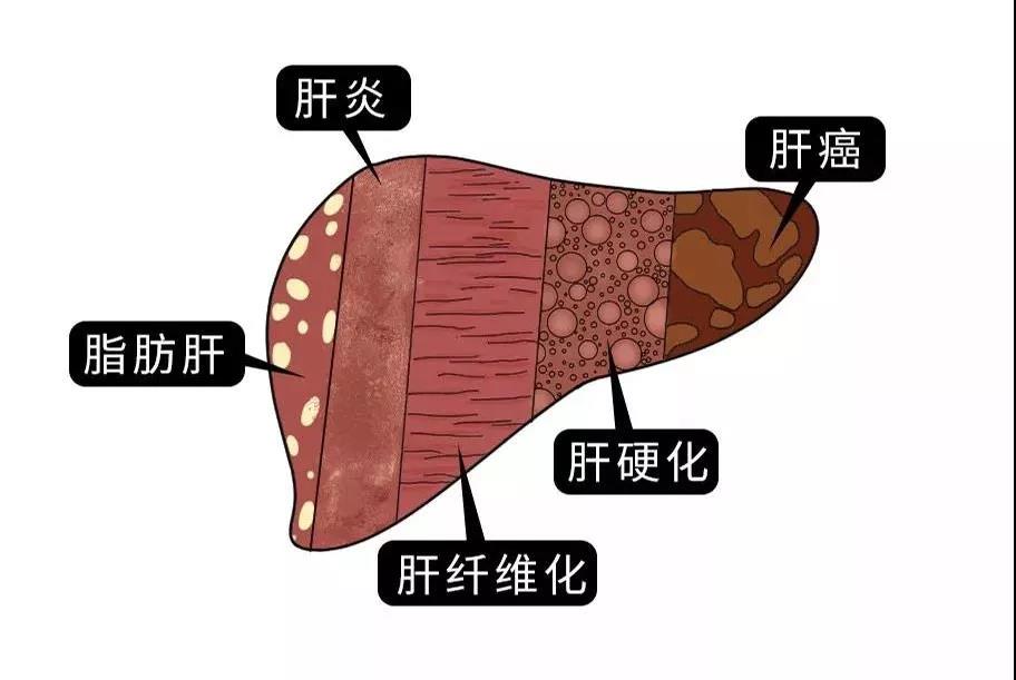 脂肪肝的最大敵人不是肥胖，答案竟是這樣！