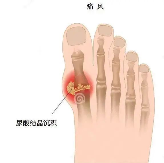 痛風(fēng)為什么偏愛男性？你最關(guān)心的問題都在這里