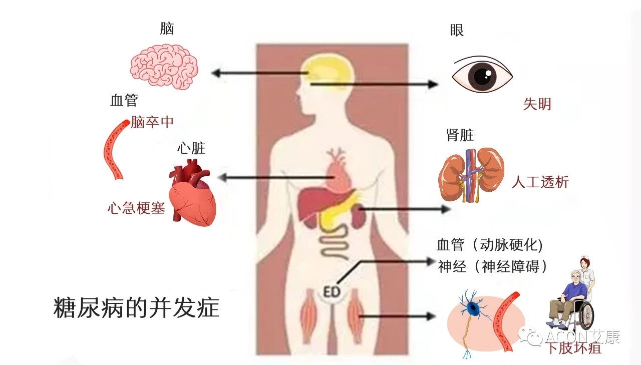 爆上熱搜，因爆發(fā)型糖尿病進(jìn)入ICU，有哪些教訓(xùn)值得我們汲取