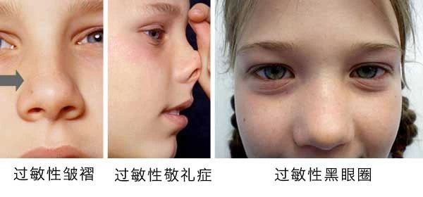 過(guò)敏性鼻炎會(huì)讓孩子變傻？！家長(zhǎng)該如何應(yīng)對(duì)